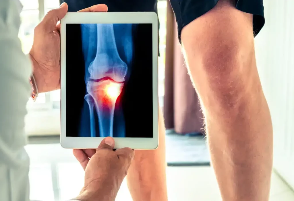 Radiographie montrant une arthrose du genou avec douleur localisée.